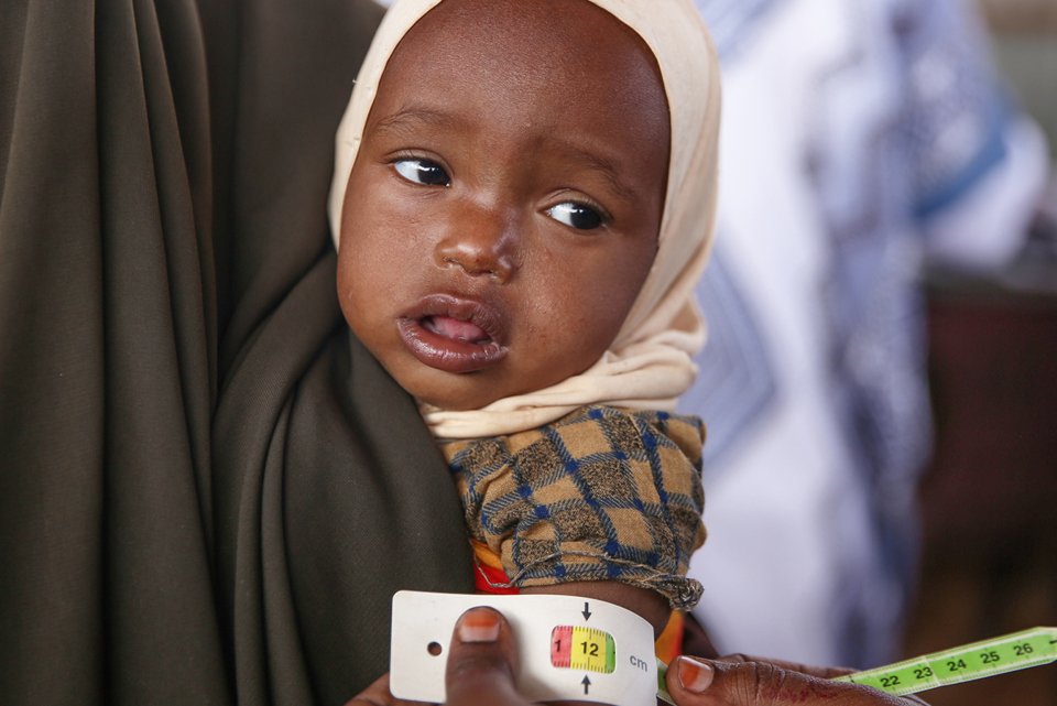 A Somalian Child Is Measured For Stunting, A Consequence Of Chronic Malnourishment